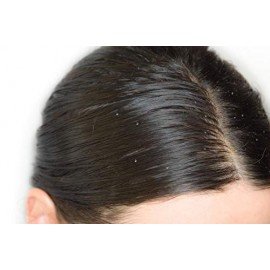 Aromatherapy Anti Dandruff Shampoo with Anti Dandruff Properties