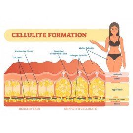 celulite skin and healthy skin