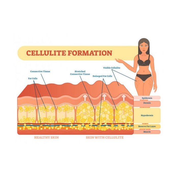 celulite skin and healthy skin