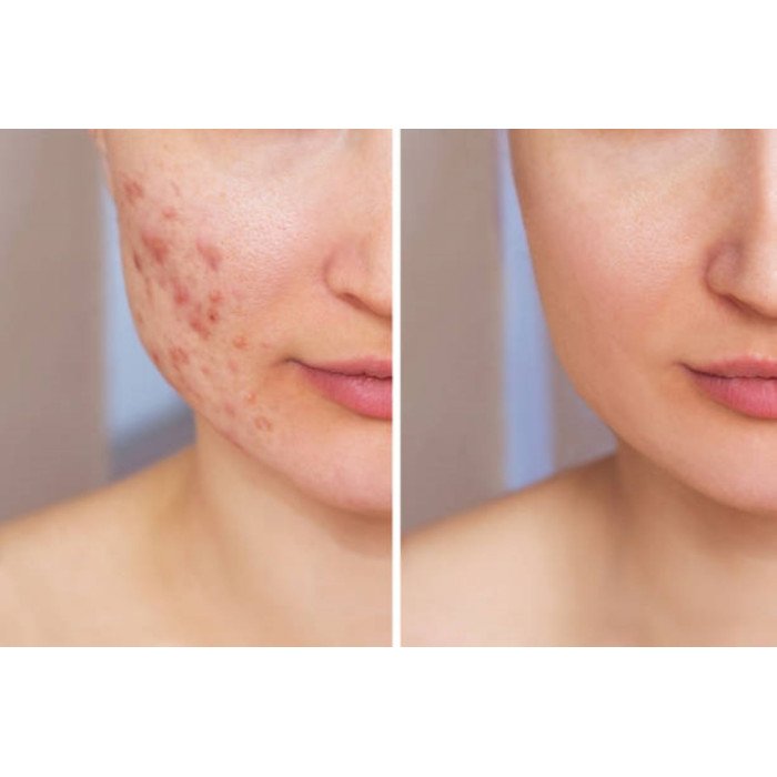 Essential Oils Blend for Acne 10 ml