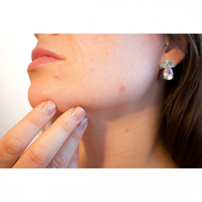 anti-acne-cream-lifestyle-image