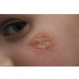 inflamed-skin-cream-lifestyle-image