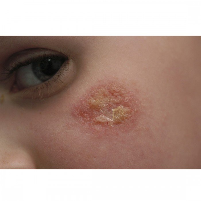 inflamed-skin-cream-lifestyle-image