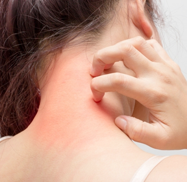 AROMATHERAPY FOR ECZEMA