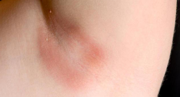 aromatherapy_for_candida