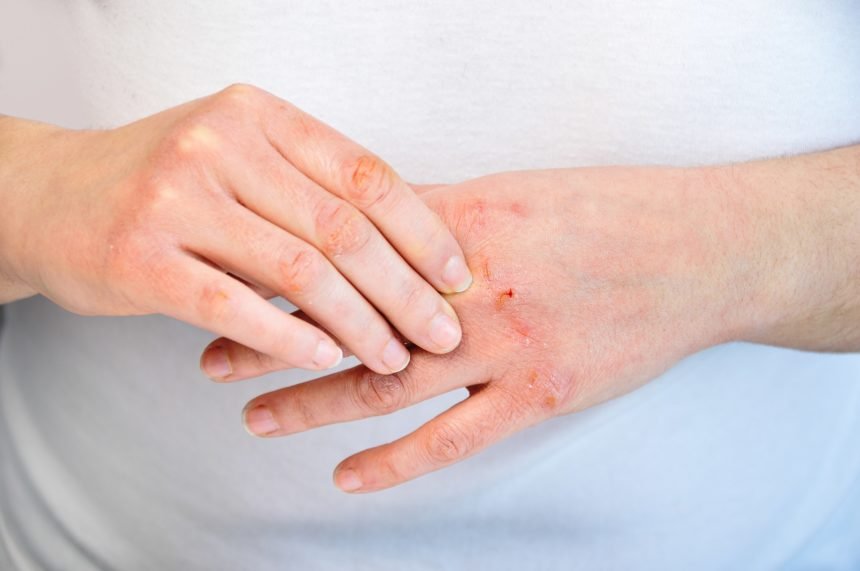 aromatherapy for dermatitis
